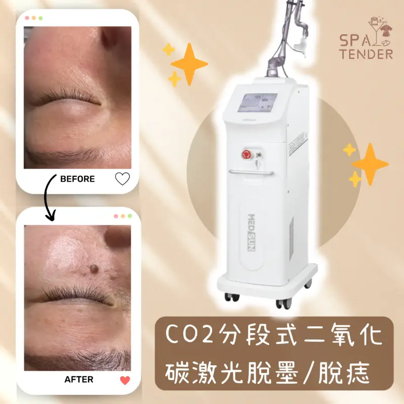 DPOAoOwkTmhbW6ci6dSnIcJ3kneXcKdtl-QbBKUdM0C ✨ CO2激光脫墨祛痣(全面)|🙆🏻 墨印痣即時淡40%|🙆🏻♀️ 激光精准擊碎色素|✨ 分段激光不傷肌膚|效果即見無痛不結痂 做完敢素顏|🔥送全館體驗!